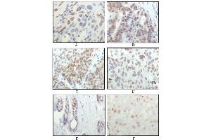 Immunohistochemical analysis of paraffin-embedded human esophageal squamous cell carcinoma (A), colon adenocarcinoma (B), liver carcinoma (C), skin carcinoma (D), breast ductal tumor (E) and brain tumor (F), showing nuclear localization using RSK1 mouse mAb with DAB staining. (RPS6KA1 antibody)