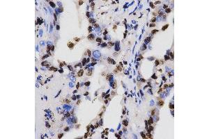 Immunohistochemistry of paraffin-embedded human lung cancer tissue using H3K4me2 antibody at dilution of 1:200 (x400 lens). (Histone 3 antibody  (H3K4me2))