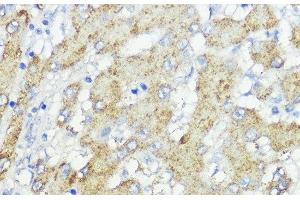 Immunohistochemistry of paraffin-embedded Human liver cancer using SOCS6 Polyclonal Antibody at dilution of 1:100 (40x lens). (SOCS6 antibody)
