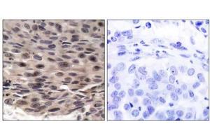 Immunohistochemical analysis of paraffin-embedded human breast carcinoma tissue using FKHRL1 (phospho-Ser253) antibody (E011222). (eIF4EBP1 antibody  (pThr36))
