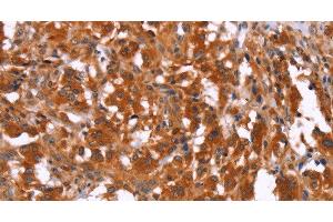 Immunohistochemistry of paraffin-embedded Human thyroid cancer using HAS1 Polyclonal Antibody at dilution of 1:30 (HAS1 antibody)