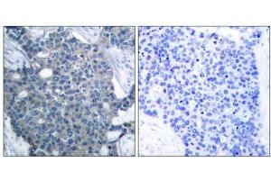 Immunohistochemical analysis of paraffin-embedded human breast carcinoma tissue using Stathmin 1 (Ab-24) antibody (E021217). (Stathmin 1 antibody)