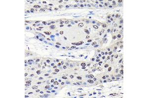 Immunohistochemistry of paraffin-embedded human esophageal cancer using GTPBP4 Rabbit pAb (ABIN1680142, ABIN3019054, ABIN3019055 and ABIN6220689) at dilution of 1:50 (40x lens).