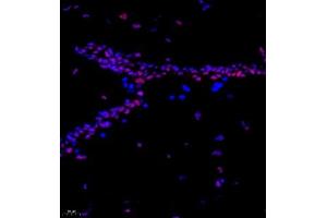 Immunofluorescence of paraffin embedded human breast cancer using CITED4 (ABIN7073356) at dilution of 1:2200 (400x lens) (CITED4 antibody)