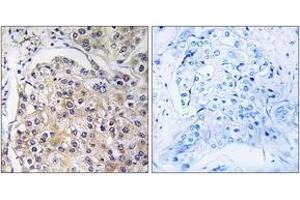 Immunohistochemistry analysis of paraffin-embedded human breast carcinoma tissue, using GPR116 Antibody. (G Protein-Coupled Receptor 116 antibody  (AA 1121-1170))
