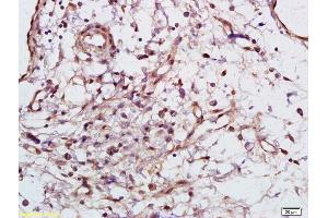 Formalin-fixed and paraffin embedded human gastric carcinoma labeled with Rabbit Anti Phospho-Syk (Tyr525/526) Polyclonal Antibody, Unconjugated (ABIN746273) at 1:200 followed by conjugation to the secondary antibody and DAB staining (SYK antibody  (pTyr525, pTyr526))