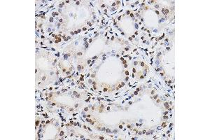 Immunohistochemistry of paraffin-embedded human thyroid cancer using PER2 Rabbit pAb (ABIN6131889, ABIN6145450, ABIN6145452 and ABIN6217063) at dilution of 1:100 (40x lens). (PER2 antibody  (AA 1-150))