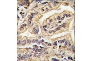 Formalin-fixed and paraffin-embedded human lung carcinoma tissue reacted with CSF1R Antibody (C-term), which was peroxidase-conjugated to the secondary antibody, followed by DAB staining. (CSF1R antibody  (C-Term))