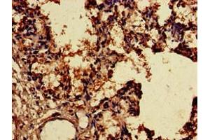 Immunohistochemistry of paraffin-embedded human lung tissue using ABIN7170356 at dilution of 1:100 (SNX15 antibody  (AA 144-321))