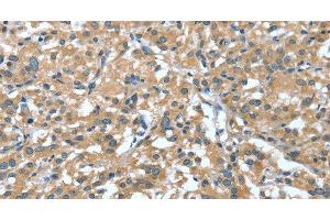 Immunohistochemistry of paraffin-embedded Human thyroid cancer tissue using DTX1 Polyclonal Antibody at dilution 1:30