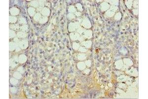 Immunohistochemistry of paraffin-embedded human colon cancer using ABIN7143999 at dilution of 1:100 (AIMP2 antibody  (AA 141-320))