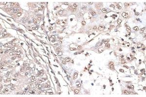 Immunohistochemistry of paraffin-embedded Human endometrium cancer using MEF2C Polyclonal Antibody at dilution of 1:100 (40x lens). (MEF2C antibody)