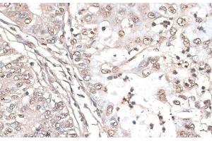 Immunohistochemistry of paraffin-embedded Human endometrium cancer using MEF2C Polyclonal Antibody at dilution of 1:100 (40x lens).