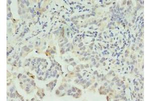 Immunohistochemistry of paraffin-embedded human lung cancer using ABIN7146041 at dilution of 1:100 (CLEC1A antibody  (AA 74-280))