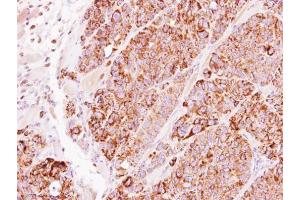 IHC-P Image Immunohistochemical analysis of paraffin-embedded SW480 xenograft, using TBRG4, antibody at 1:500 dilution. (TBRG4 antibody)
