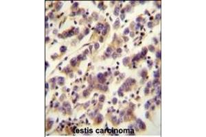 OR1J4 antibody (C-term) (ABIN655015 and ABIN2844648) immunohistochemistry analysis in formalin fixed and paraffin embedded human testis carcinoma followed by peroxidase conjugation of the secondary antibody and DAB staining. (OR1J4 antibody  (C-Term))