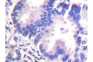 Immunohistochemical analysis of paraffin-embedded human lung carcinoma tissue using SNCG polyclonal antibody . (SNCG antibody)