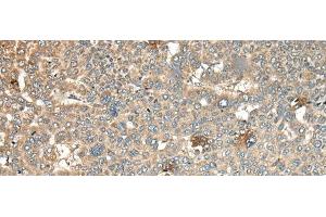 Immunohistochemistry of paraffin-embedded Human liver cancer tissue using CA11 Polyclonal Antibody at dilution of 1:45(x200)