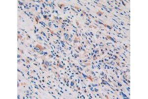 IHC-P analysis of stomach cancer tissue, with DAB staining.