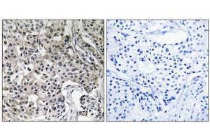 Immunohistochemistry analysis of paraffin-embedded human breast carcinoma tissue using USP19 antibody. (USP19 antibody  (Internal Region))