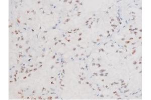 ABIN6267578 at 1/200 staining Human lung cancer tissue sections by IHC-P. (FOXO4 antibody  (pThr451))