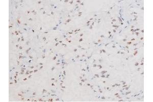 ABIN6267578 at 1/200 staining Human lung cancer tissue sections by IHC-P.