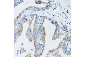 Immunohistochemistry of paraffin-embedded human gastric cancer using USO1 antibody (ABIN1875291) at dilution of 1:100 (40x lens). (USO1 antibody)