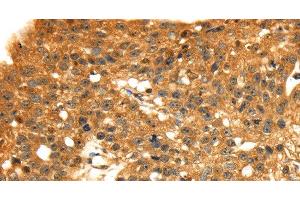Immunohistochemistry of paraffin-embedded Human breast cancer tissue using STX8 Polyclonal Antibody at dilution 1:45
