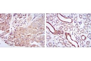 Immunohistochemical analysis of paraffin-embedded lung cancer tissues (left) and kidney tissues (right) using PODXL mouse mAb with DAB staining.