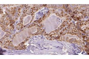 ABIN6273353 at 1/100 staining Human thyroid cancer tissue by IHC-P.