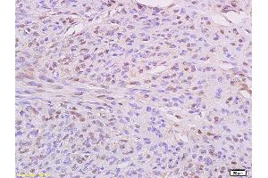 Formalin-fixed and paraffin embedded human cervical carcinoma labeled with Anti IKBKE/IKKi Polyclonal Antibody, Unconjugated (ABIN754033) at 1:200 followed by conjugation to the secondary antibody and DAB staining (IKKi/IKKe antibody  (AA 501-600))