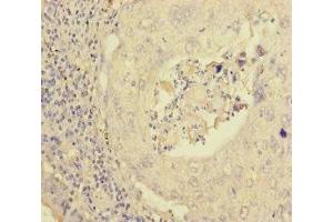 Immunohistochemistry of paraffin-embedded human lung cancer using ABIN7162979 at dilution of 1:100 (PEX16 antibody  (AA 132-336))