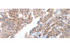 Immunohistochemistry of paraffin-embedded Human breast cancer tissue using COX7C Polyclonal Antibody at dilution of 1:40(x200) (COX7C antibody)