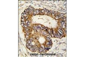 Formalin-fixed and paraffin-embedded human colon carcinoma tissue reacted with PHB2 Antibody  (ABIN391412 and ABIN2841409) , which was peroxidase-conjugated to the secondary antibody, followed by DAB staining. (Prohibitin 2 antibody  (AA 106-134))