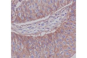 Immunohistochemical analysis of paraffin-embedded human blader cancer, using JAM1 Antibody. (Recombinant F11R antibody)