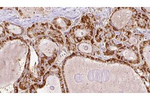 ABIN6267201 at 1/100 staining Human thyroid cancer tissue by IHC-P. (TRAF2 antibody  (pSer11))