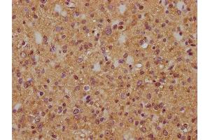 IHC image of ABIN7174981 diluted at 1:200 and staining in paraffin-embedded human glioma cancer performed on a Leica BondTM system. (Myosin XVIIIA antibody  (AA 1849-2054))