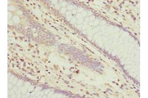 Immunohistochemistry of paraffin-embedded human colon cancer using ABIN7173929 at dilution of 1:100