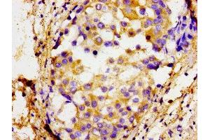 Immunohistochemistry of paraffin-embedded human breast cancer using ABIN7172602 at dilution of 1:100 (SOX11 antibody  (AA 241-341))