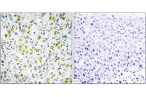 Immunohistochemistry analysis of paraffin-embedded human liver carcinoma tissue, using CHD4 Antibody. (CHD4 antibody  (AA 571-620))