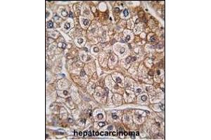 Formalin-fixed and paraffin-embedded human hepatocarcinoma tissue reacted with BR2 antibody (N-term), which was peroxidase-conjugated to the secondary antibody, followed by DAB staining. (BMPR2 antibody  (N-Term))