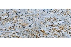 Immunohistochemistry of paraffin-embedded Human cervical cancer tissue using IL17RD Polyclonal Antibody at dilution of 1:40(x200) (IL17RD antibody)