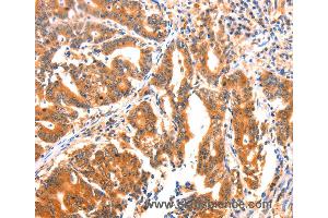 Immunohistochemistry of Human thyroid cancer using AK5 Polyclonal Antibody at dilution of 1:60