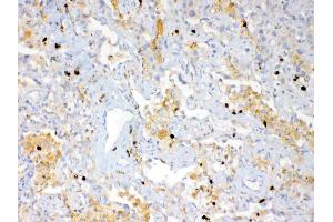 IHC analysis of Psoriasin using anti-Psoriasin antibody . (S100A7 antibody  (AA 2-101))