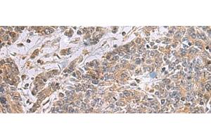Immunohistochemistry of paraffin-embedded Human colorectal cancer tissue using UBTD1 Polyclonal Antibody at dilution of 1:25(x200) (UBTD1 antibody)