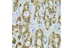 Immunohistochemistry of paraffin-embedded human rectal cancer using RPS7 antibody. (RPS7 antibody  (AA 1-194))