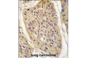 Formalin-fixed and paraffin-embedded human lung carcinoma tissue reacted with WIF1 (Human C-term) (ABIN389184 and ABIN2839347) , which was peroxidase-conjugated to the secondary antibody, followed by DAB staining.