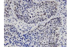 Immunoperoxidase of monoclonal antibody to HNF1B on formalin-fixed paraffin-embedded human lung adenocarcinoma. (HNF1B antibody  (AA 29-118))
