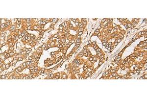 Immunohistochemistry of paraffin-embedded Human liver cancer tissue using GNB1L Polyclonal Antibody at dilution of 1:35(x200) (GNB1L antibody)