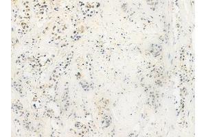 ABIN6259154 and ABIN6275369 at 1/100 staining human esophageal carcinoma by IHC-P.